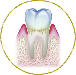 西東京市西原町・おばら歯科医院・歯周病治療
