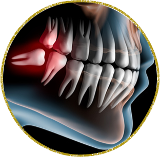 西東京市西原町・おばら歯科医院・親知らず・抜歯・口内炎の治療と外科的処置